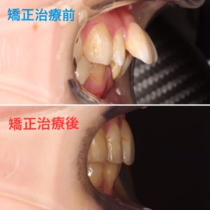 抜歯矯正による前歯 横顔の変化 カレブラン Carre Blanc 矯正歯科 恵比寿